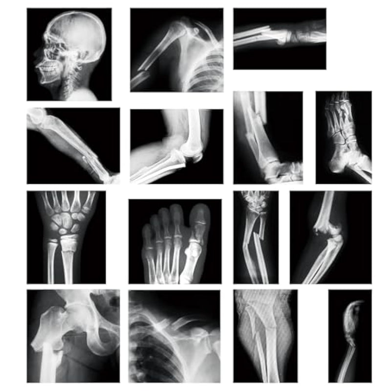 15 Pcs Broken Bones X Ray Set Human X Rays Black And White Skeleton Pretend Xr